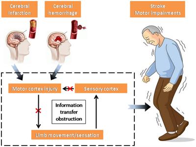 Influencing factors of corticomuscular coherence in stroke patients